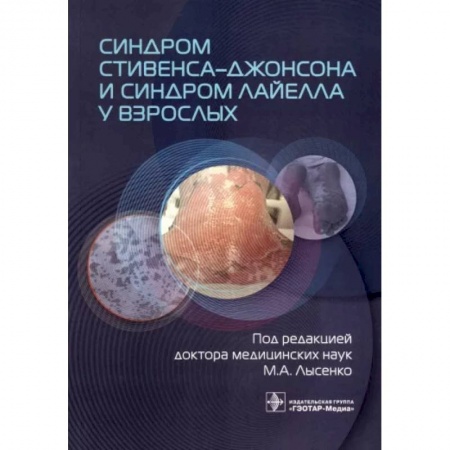 Терапия. Пульмонология, книга Синдром Стивенса-Джонсона и синдром Лайелла у взрослых заказать