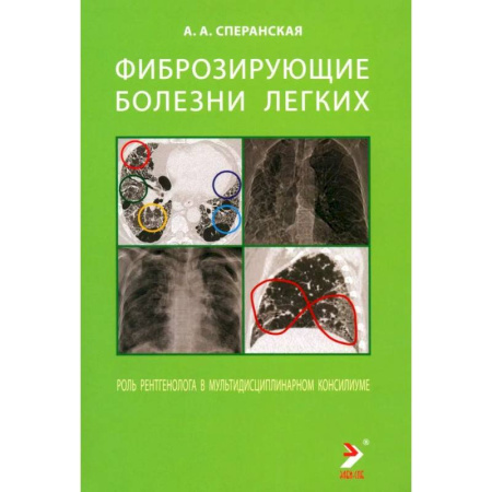 Органы дыхания. Туберкулез. Астма, книга Фиброзирующие болезни легких. Роль рентгенолога в мультидисциплинарном консилиуме заказать