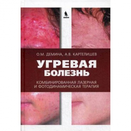 Медицинские энциклопедии и справочники, книга Угревая болезнь. Комбинированная лазерная и фотодинамическая терапия заказать